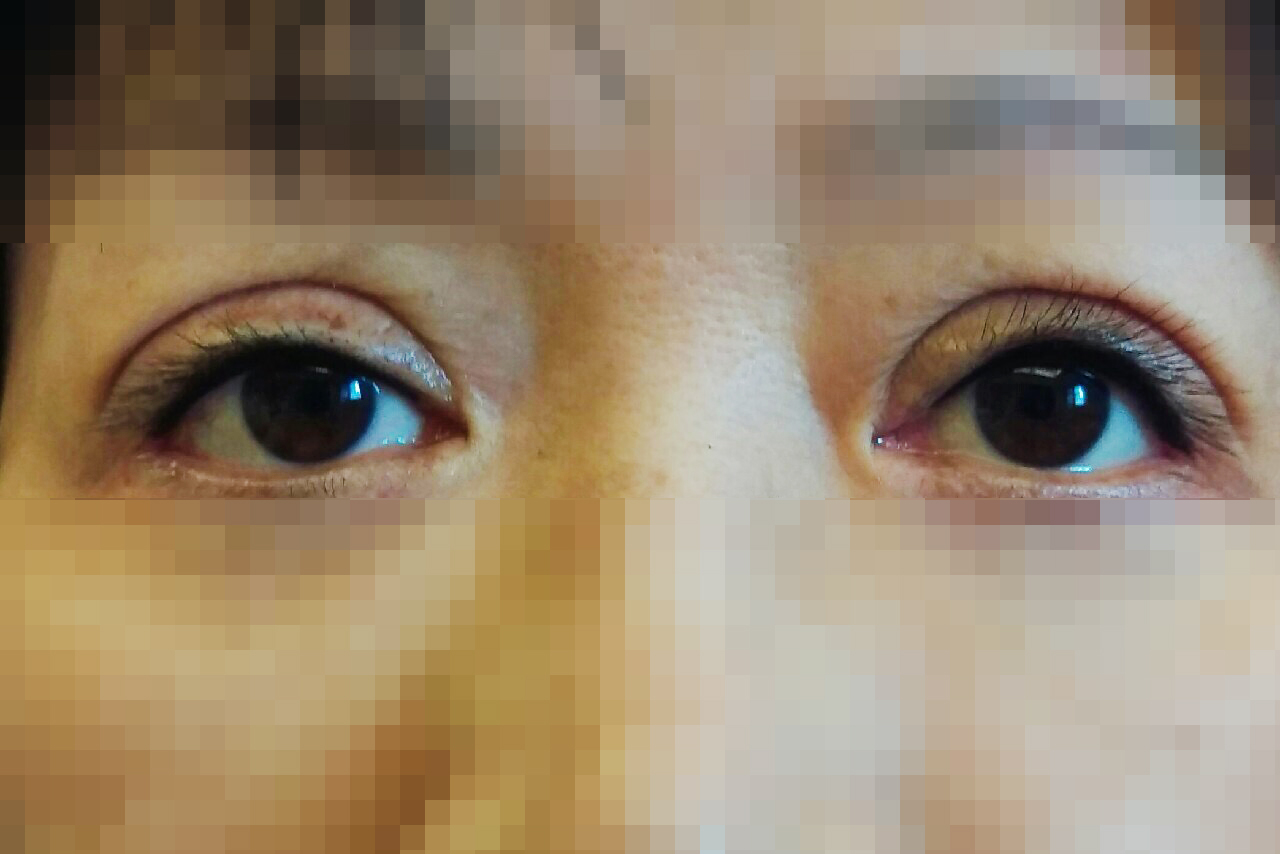 割雙眼皮失敗,用眼線補救